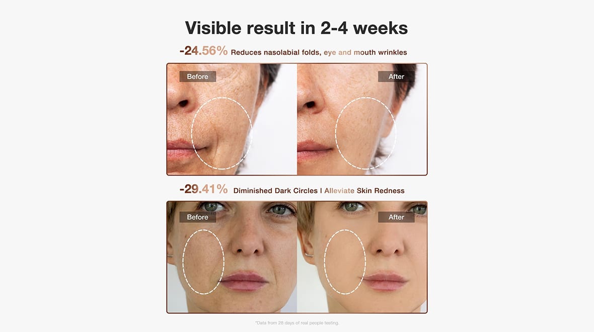 جوفز 4D قناع علاج الضوء بالليزر